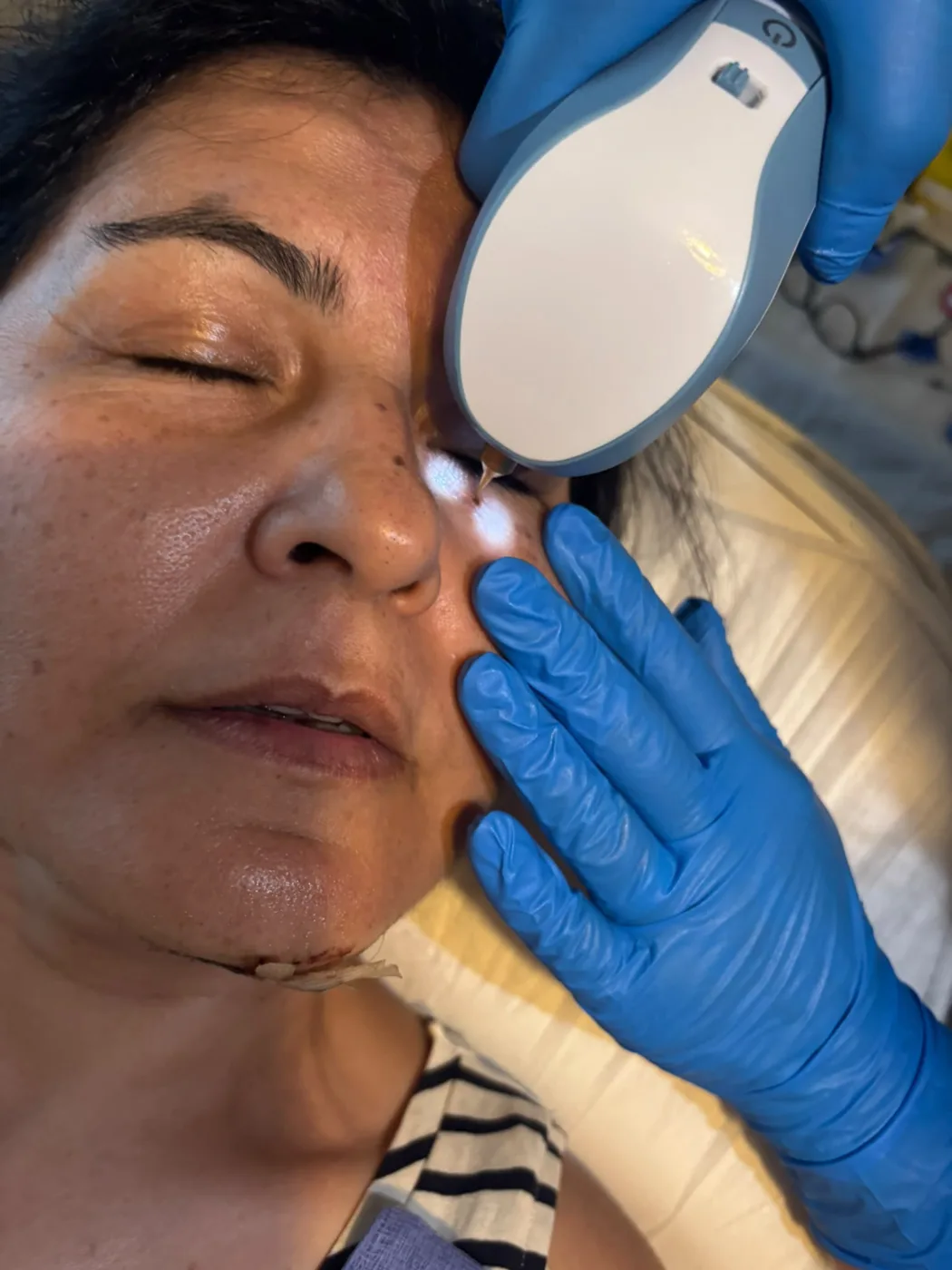 Tear trough treatment under the eye with Mel Barge in Oakham