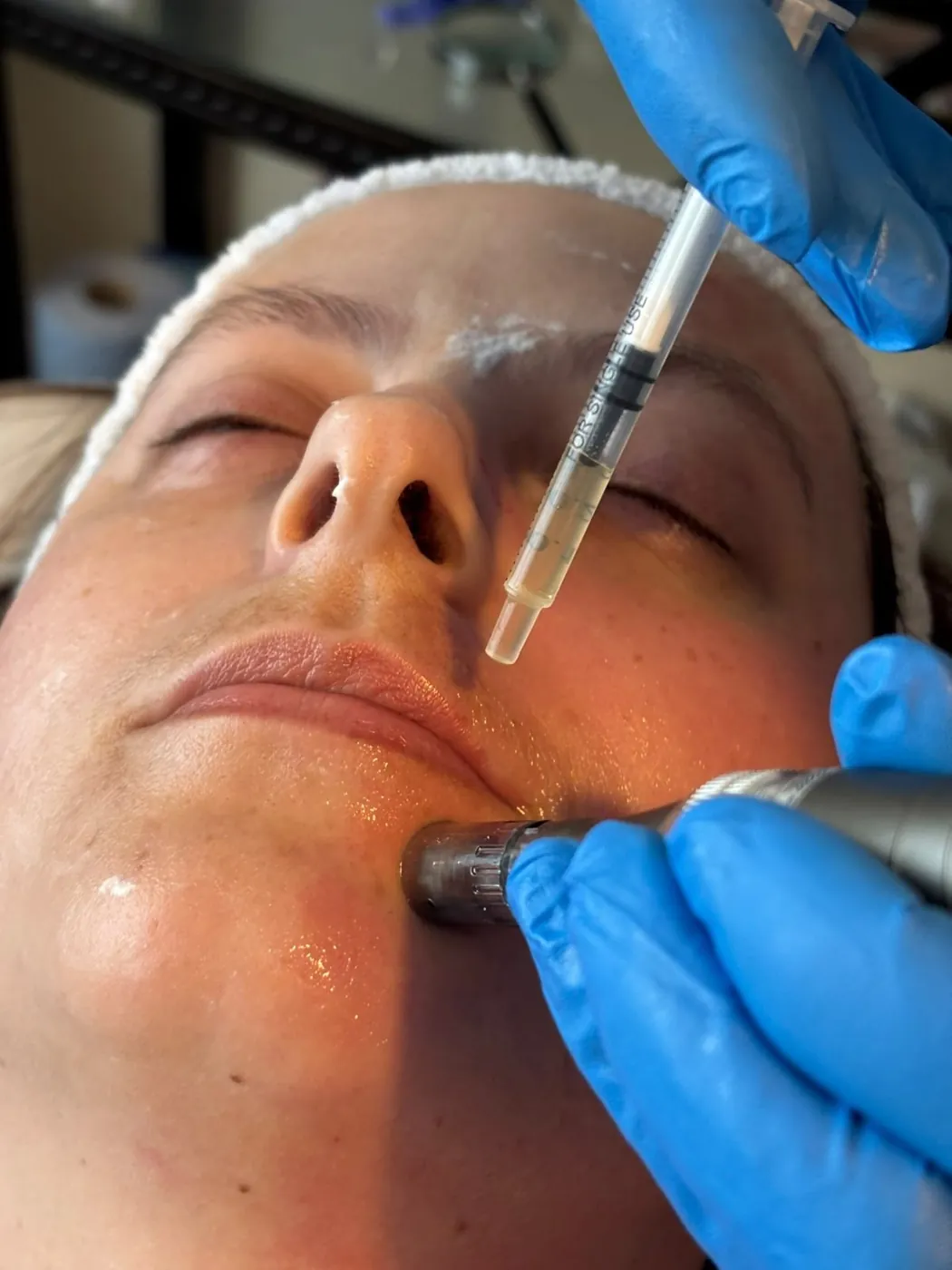 Microneedling pen and serum applied to the face in Oakham