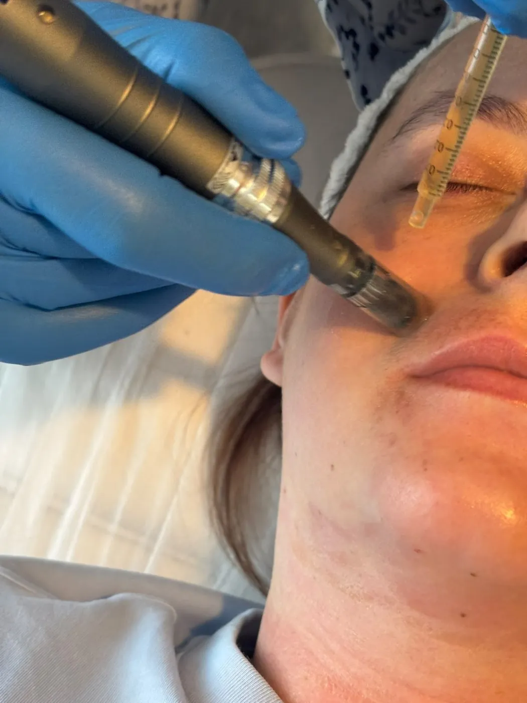 Microneedling pen on the cheek with serum in Oakham
