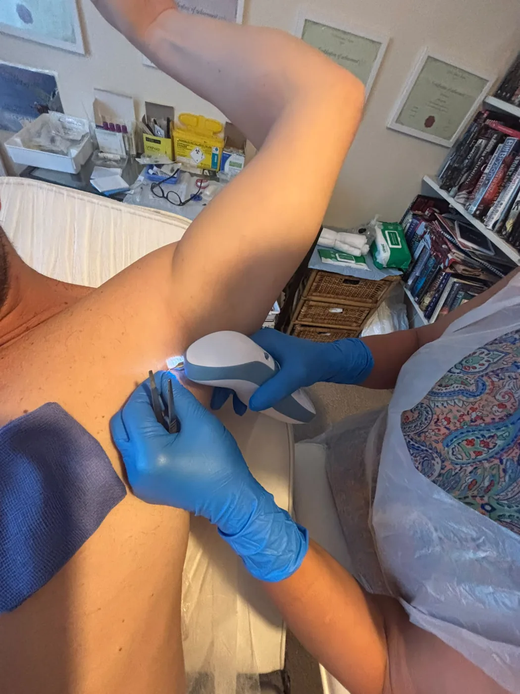 Underarm hyperhidrosis treatment with Mel Barge in Oakham