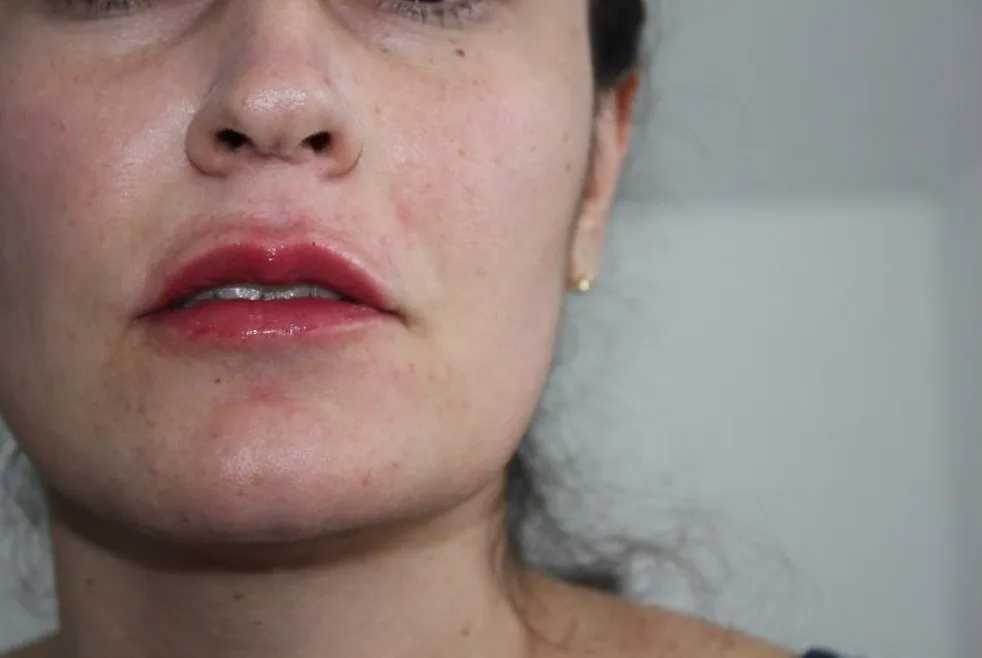 Soft, natural lip filler result in Oakham, Rutland
