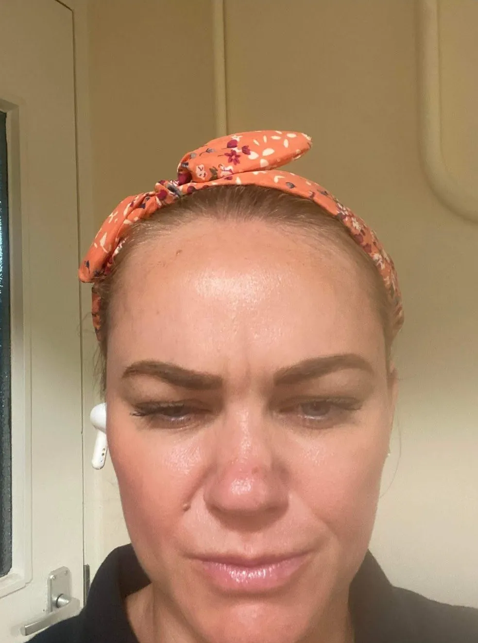Before anti-wrinkle injections – Client showing frown lines before anti-wrinkle injections in Oakham, Rutland