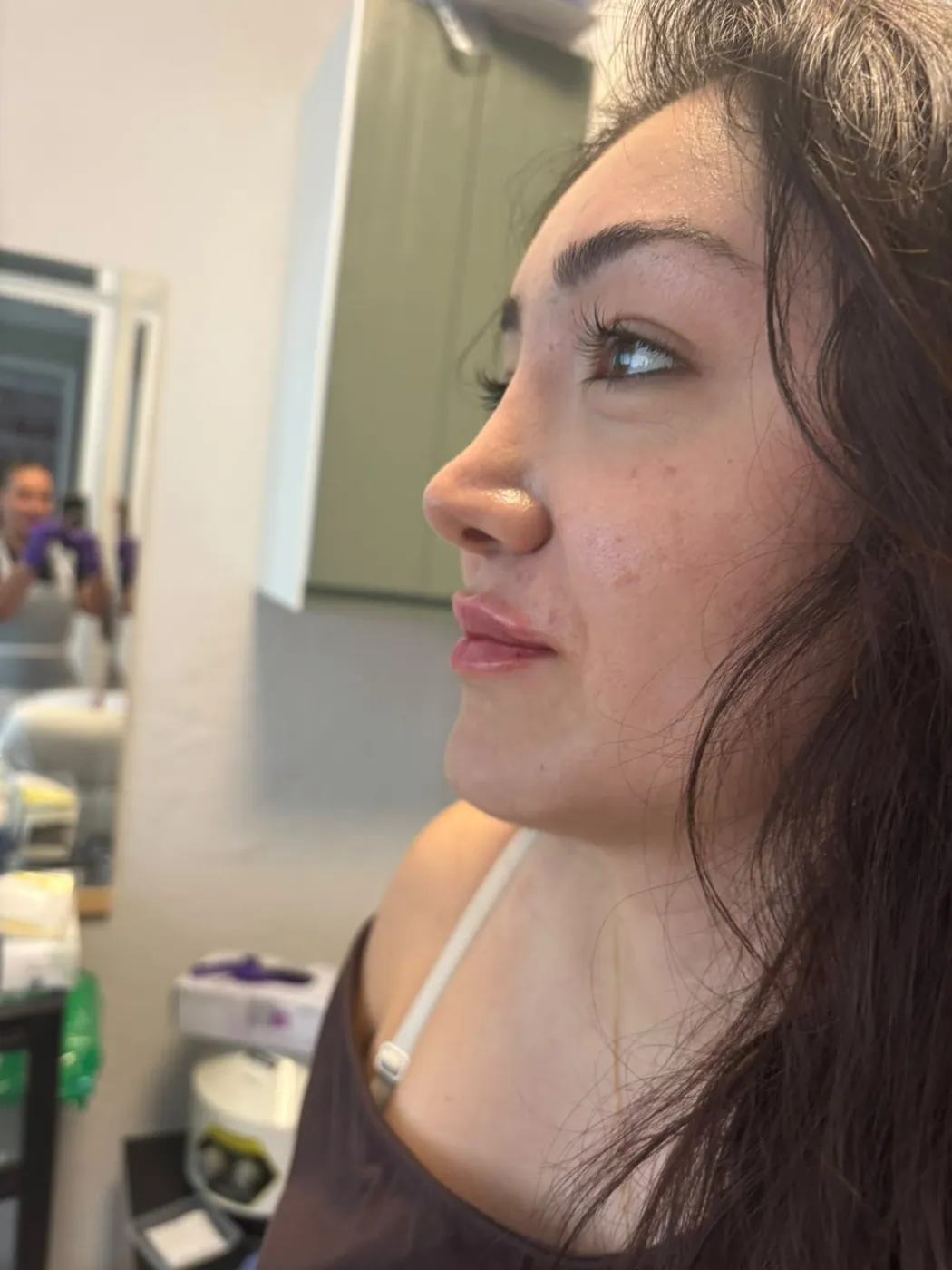 Lip filler results with Mel Barge in Oakham, Rutland