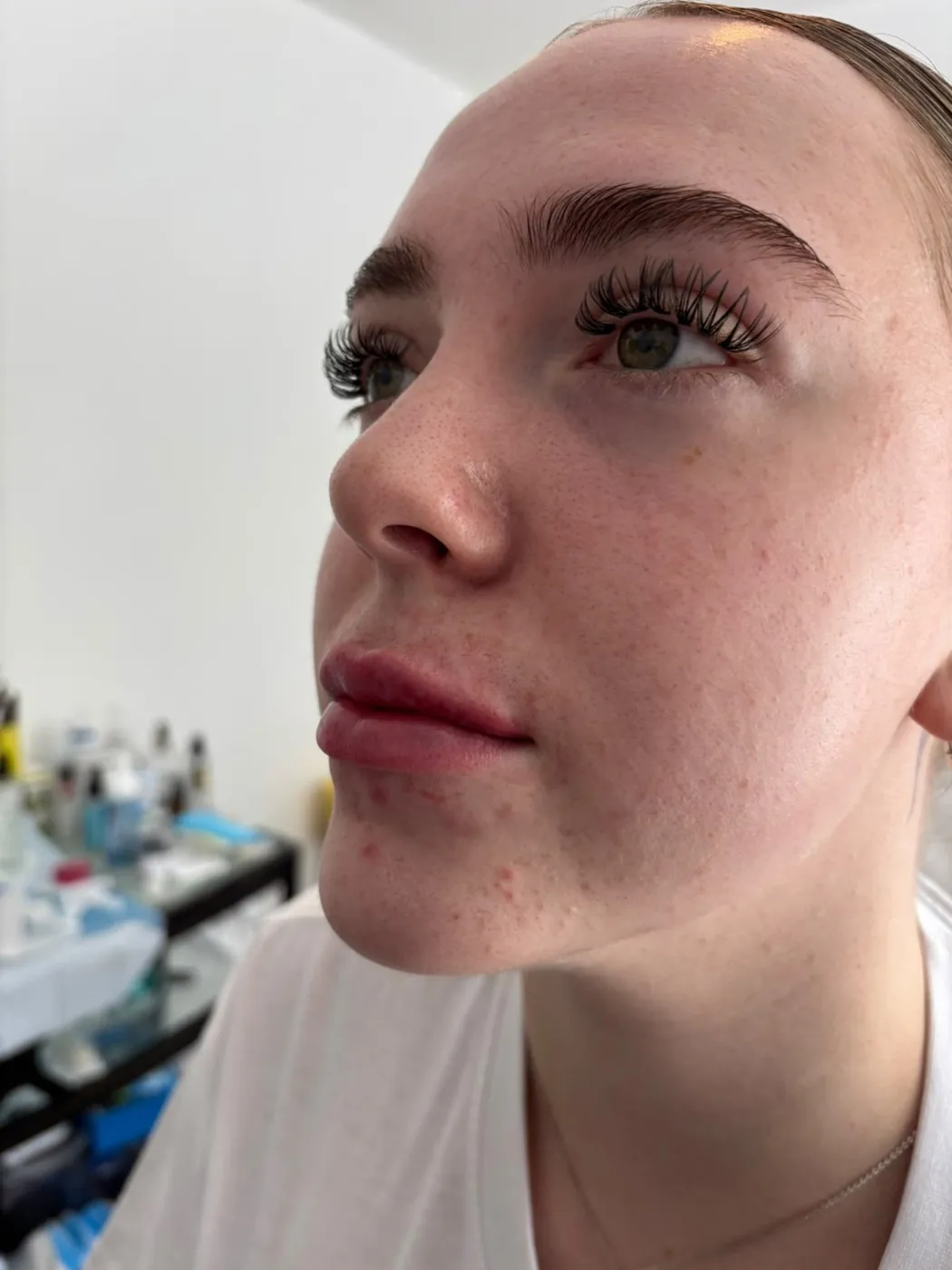 Balanced lip filler result by Mel Barge, Oakham
