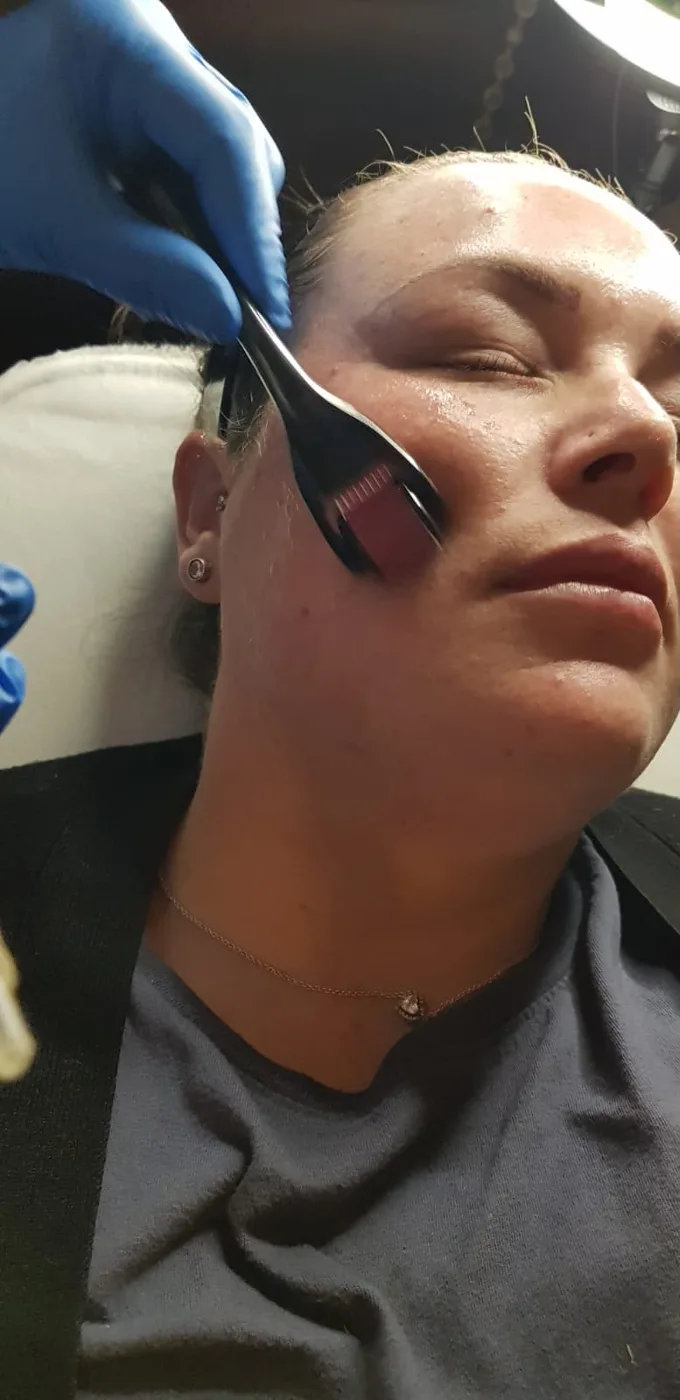 Skin treatment on the cheek with Mel Barge in Oakham