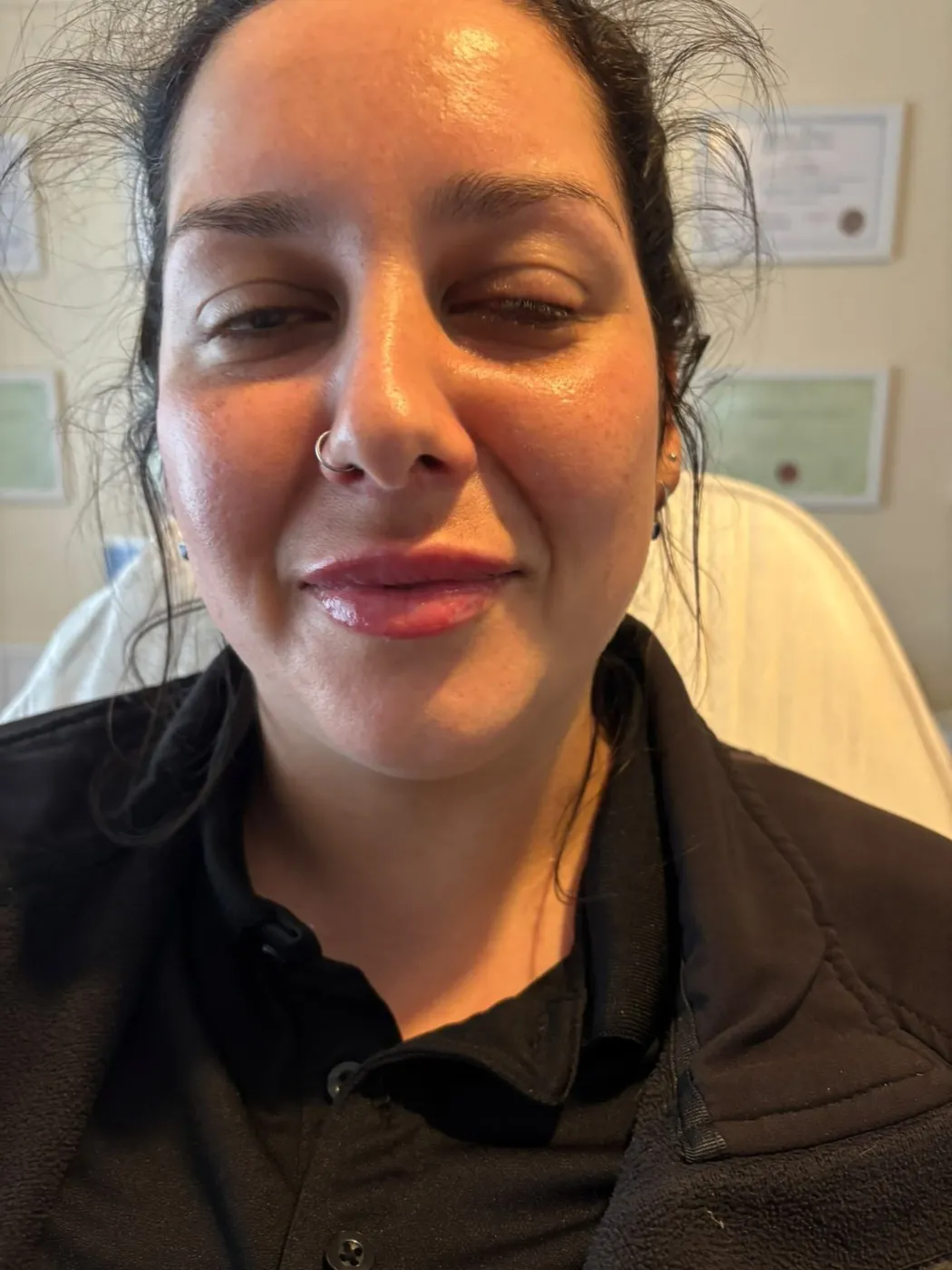 Natural lip filler result with Mel Barge in Oakham