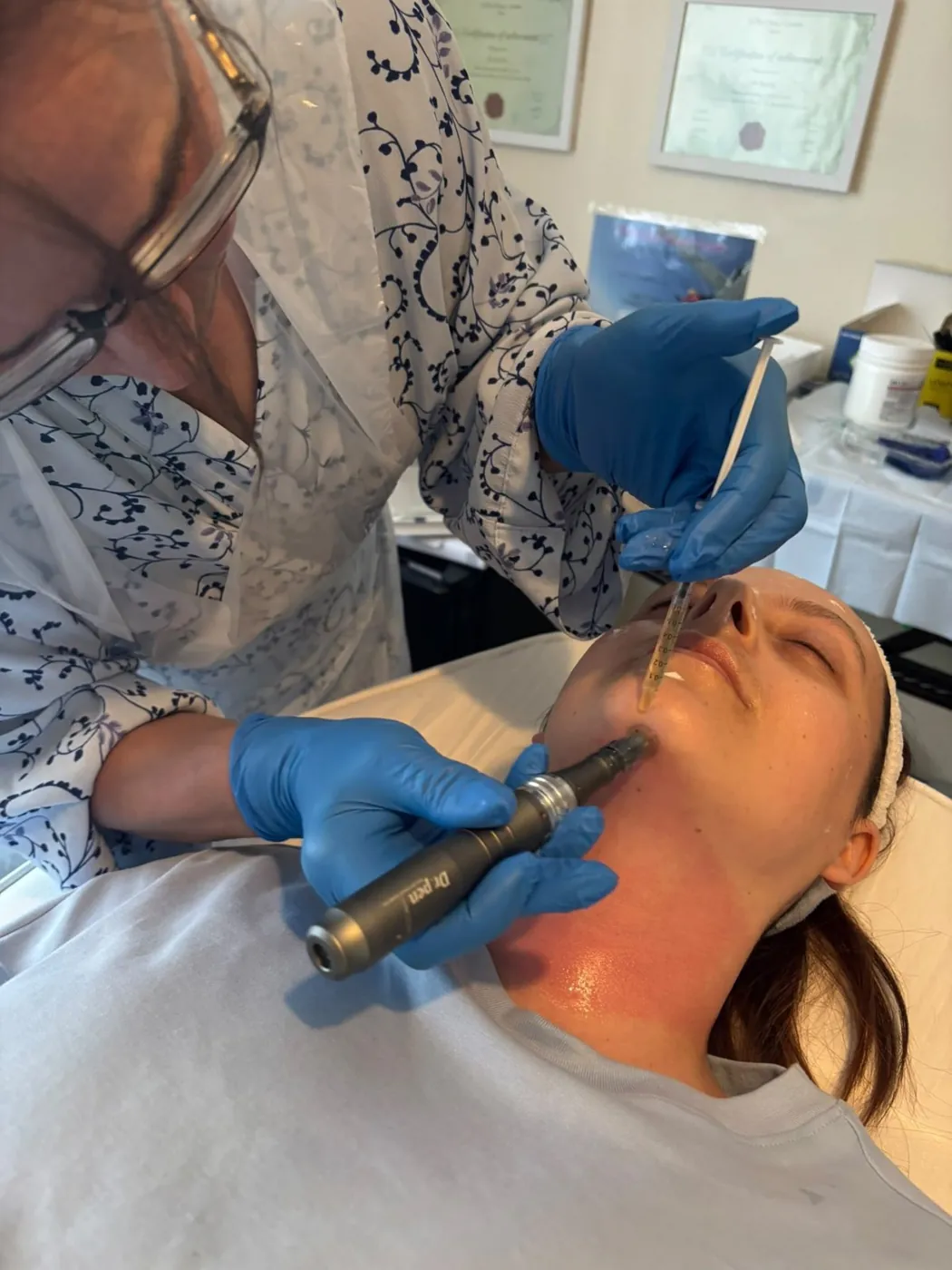 Microneedling along the jawline in Mel Barge's Oakham treatment room