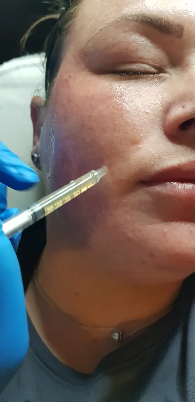 Skin booster injection to the lower cheek in Oakham