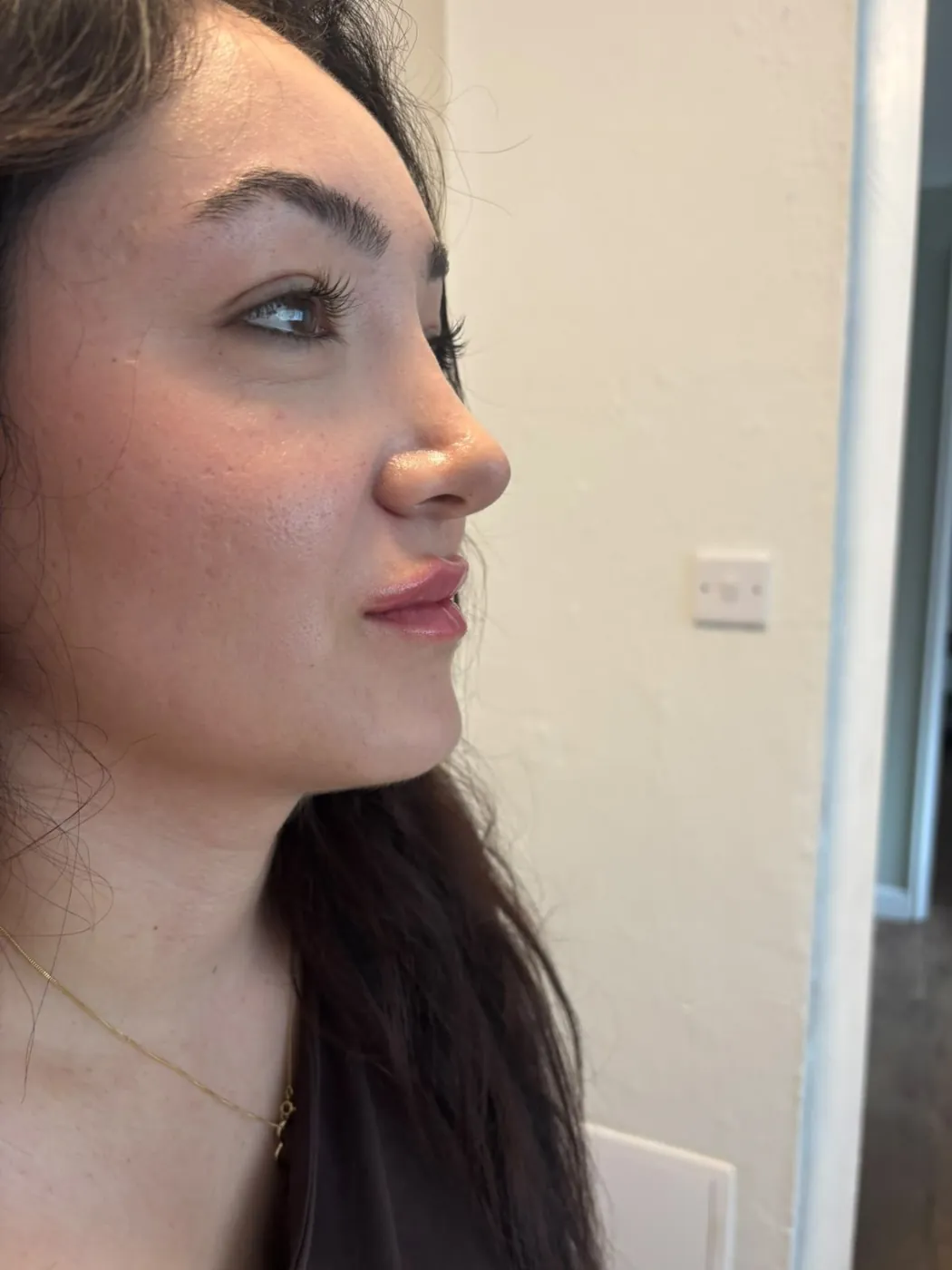 After lip filler – Side profile showing lip filler results in Oakham