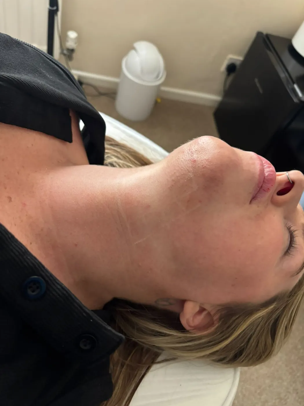 Refreshed jawline after a non-surgical mini face and neck lift in Oakham