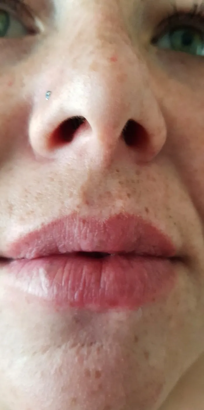 Natural lip filler result after treatment with Mel Barge in Oakham