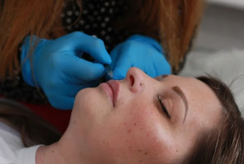Mel Barge injecting lip filler into the upper lip in Oakham