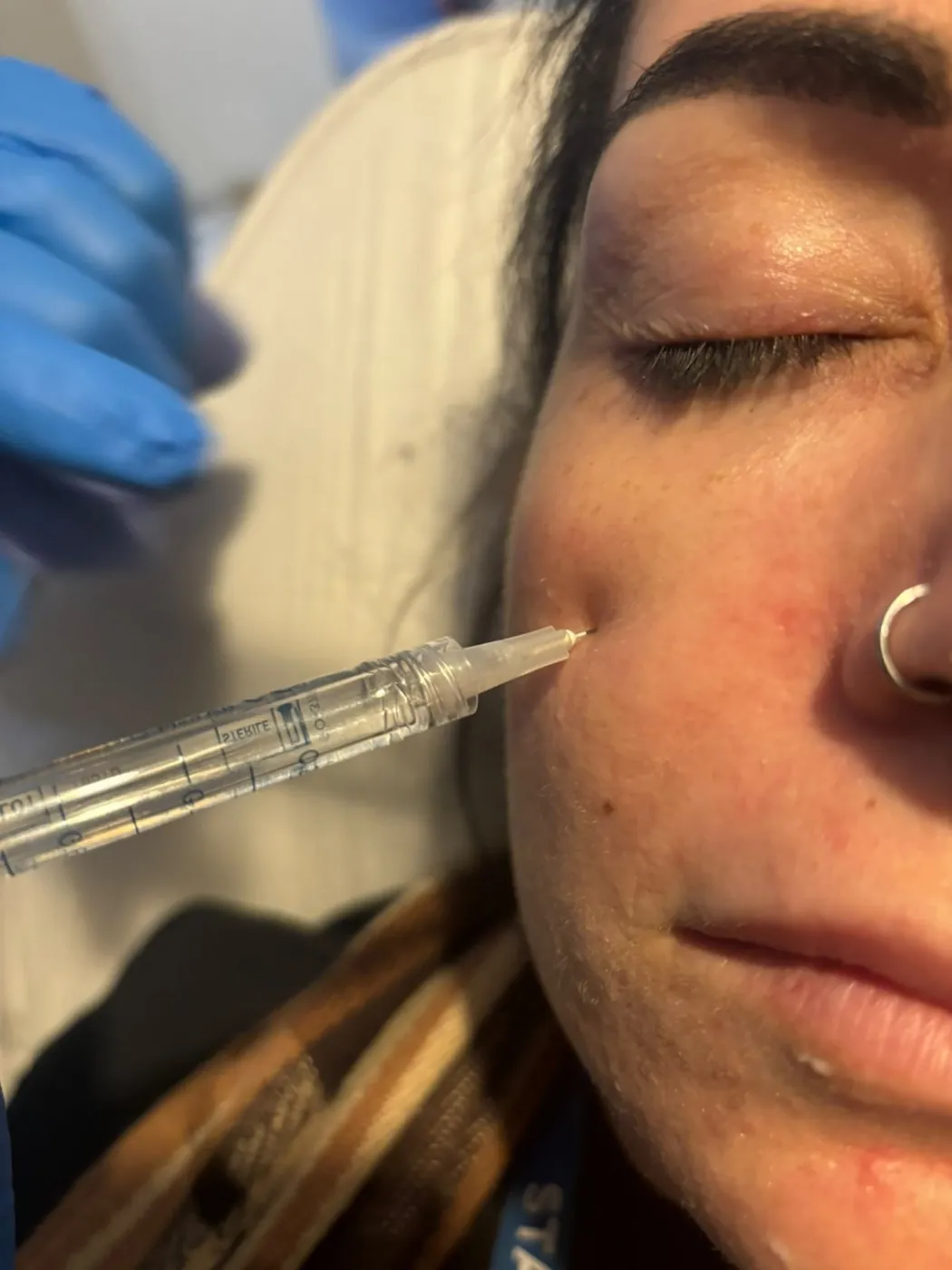 Skin booster injection into the cheek in Oakham, Rutland