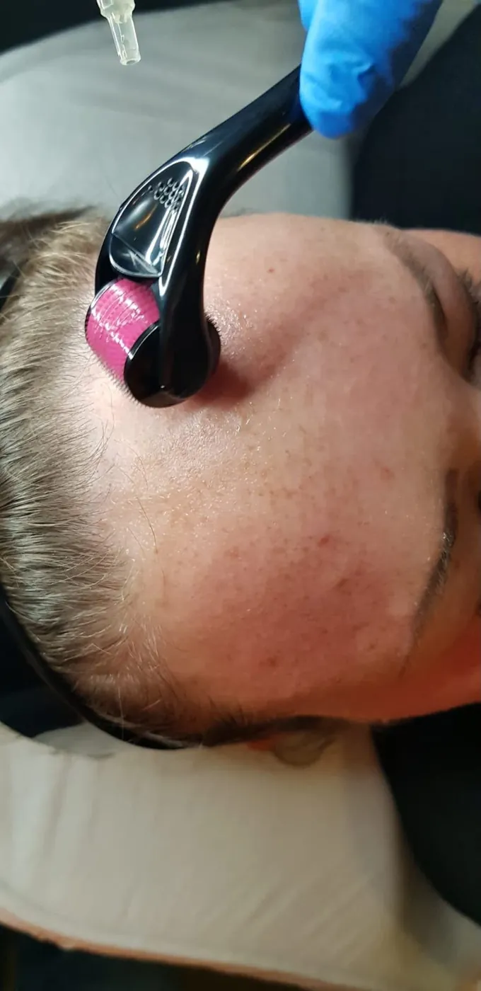 Derma roller microneedling on the forehead in Oakham, Rutland