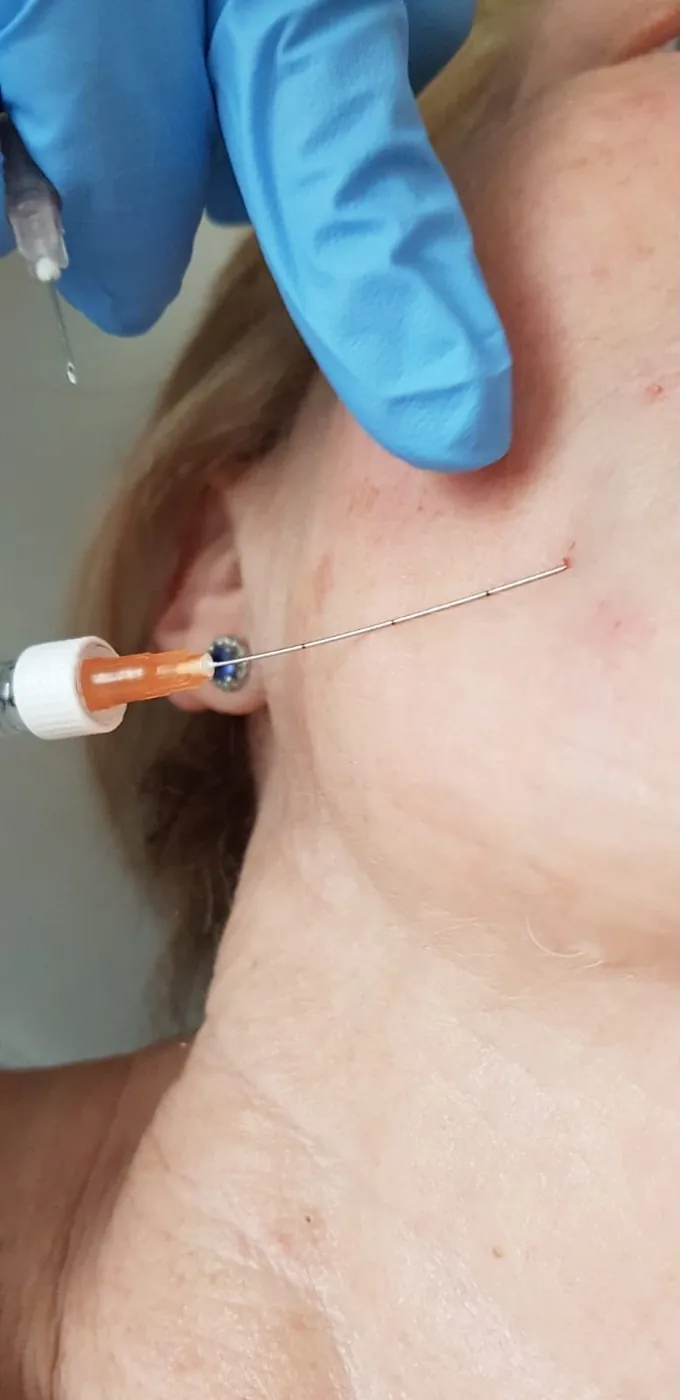 Non-surgical lift treatment along the jawline in Oakham, Rutland