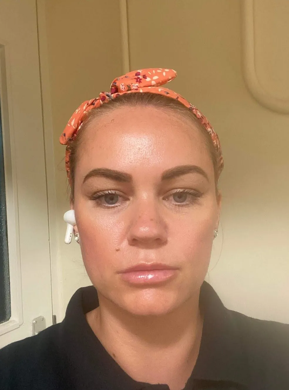 After anti-wrinkle injections – Anti-wrinkle injections with Mel Barge in Oakham