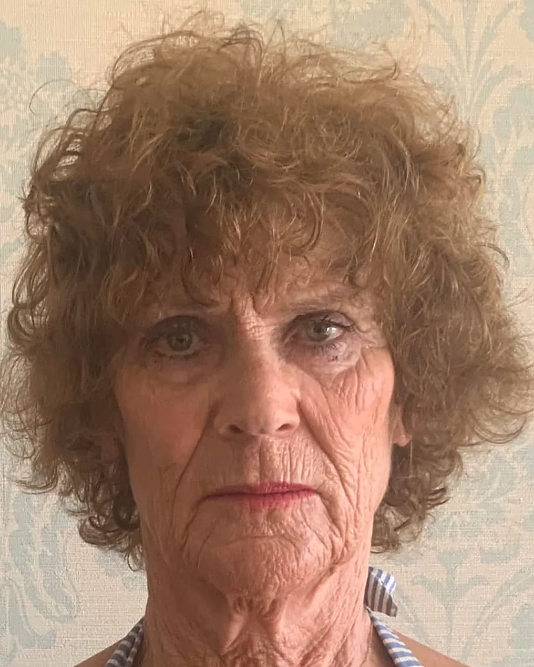 Before anti-wrinkle injections – Client before anti-wrinkle injections in Oakham, showing lines across the face