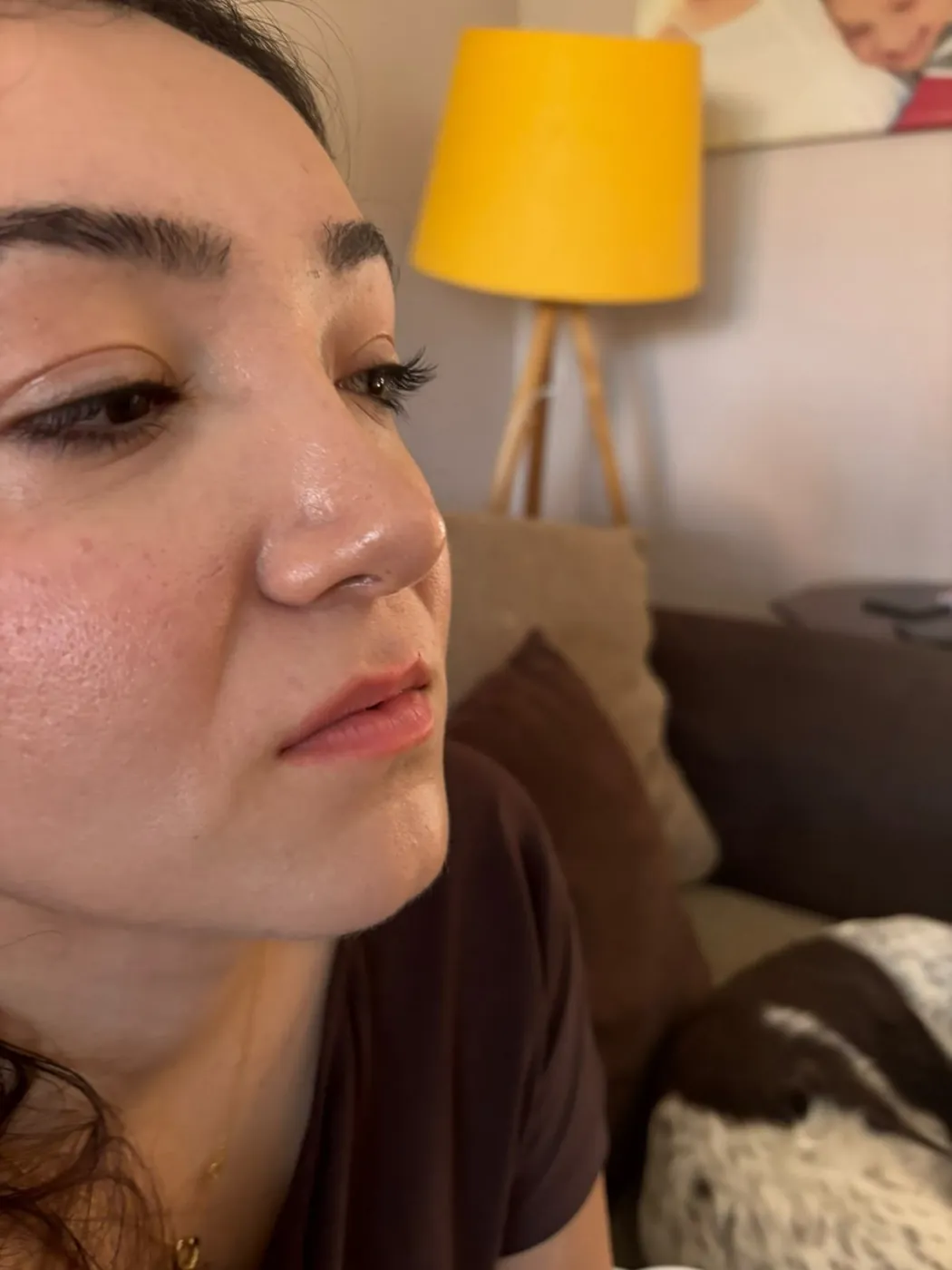 Before lip filler – Lip filler results with Mel Barge in Oakham, Rutland
