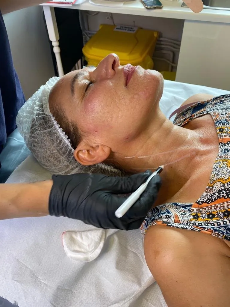 Neck and jawline mapped before a non-surgical mini face and neck lift in Oakham