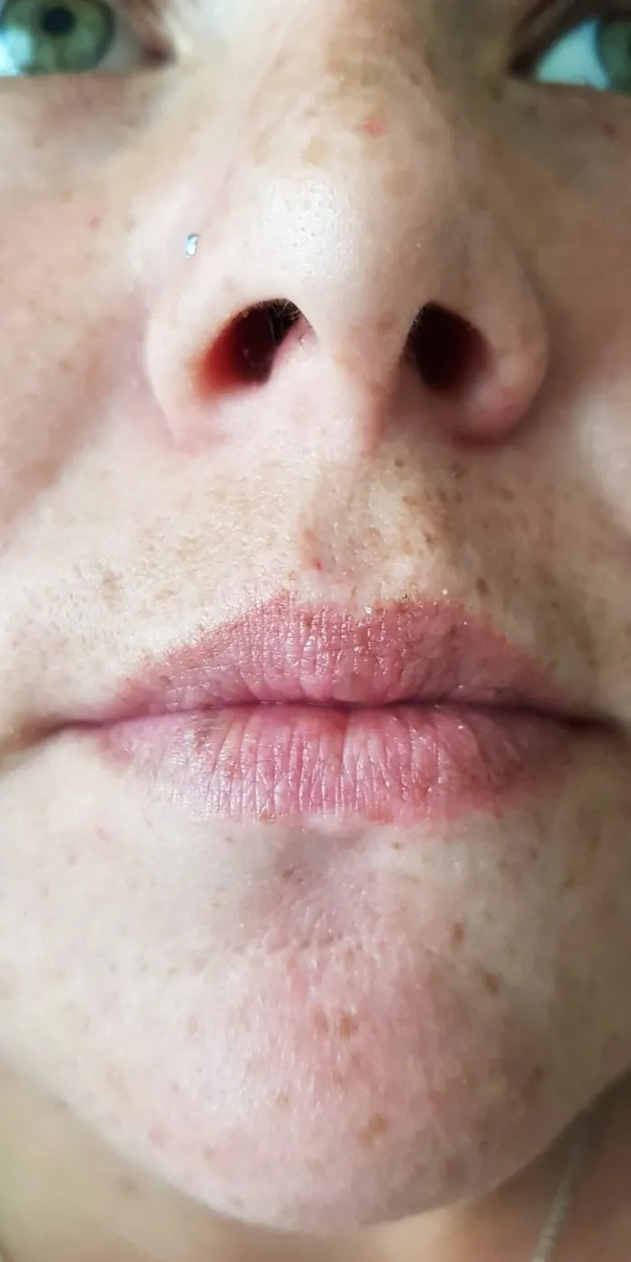 Before lip filler – Lip filler results with Mel Barge in Oakham, Rutland