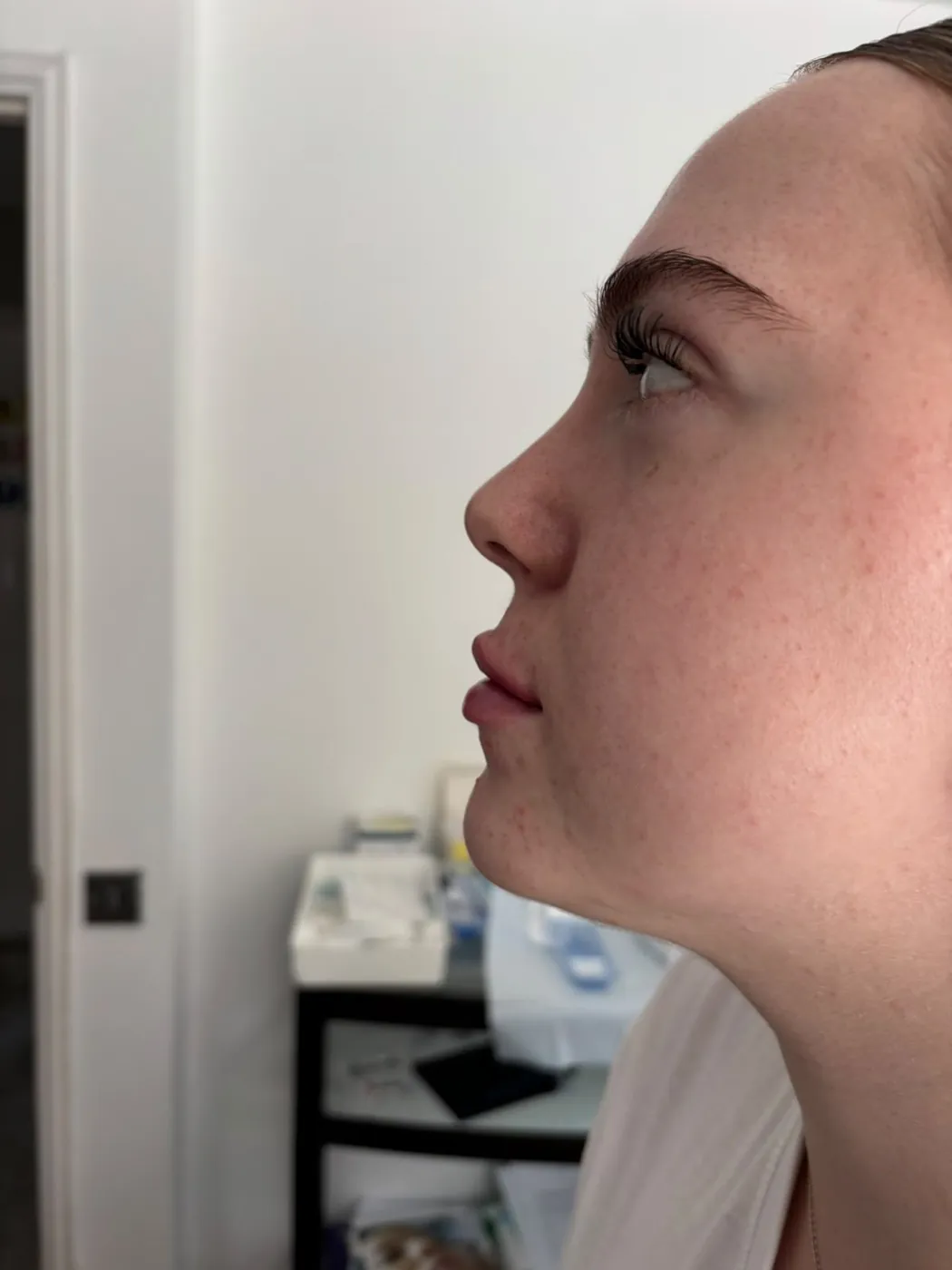 Side profile after lip filler treatment in Oakham, Rutland