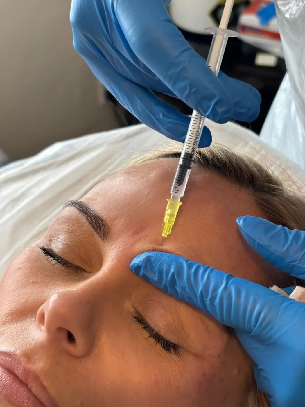 Close-up of an anti-wrinkle injection into the forehead in Oakham