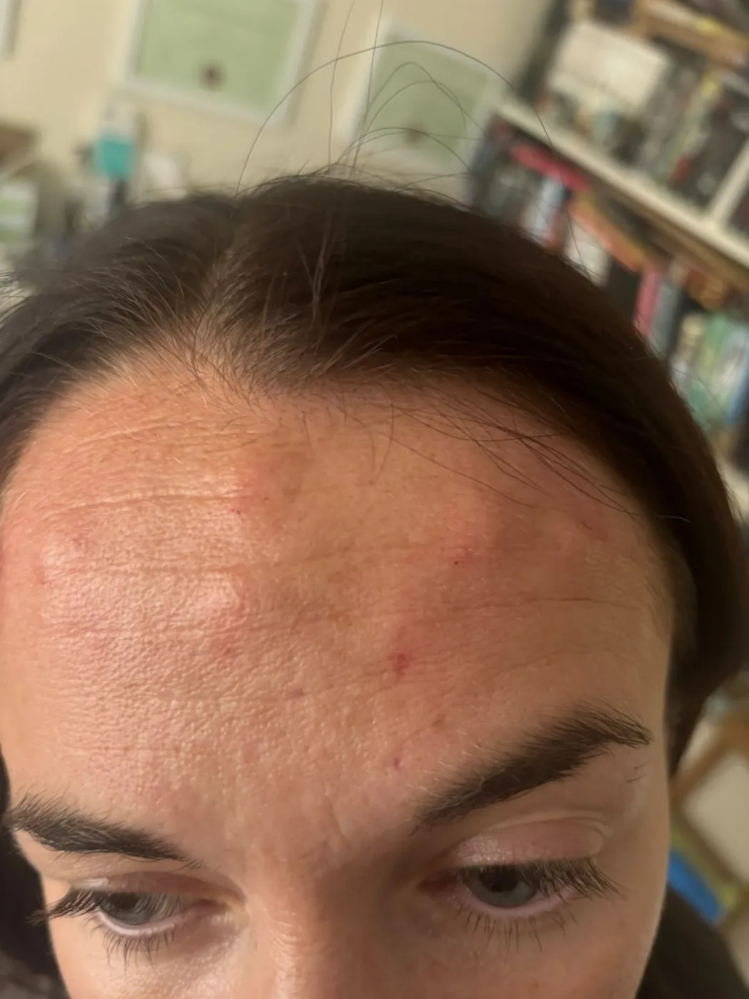 Smoother skin after microneedling with Mel Barge in Oakham