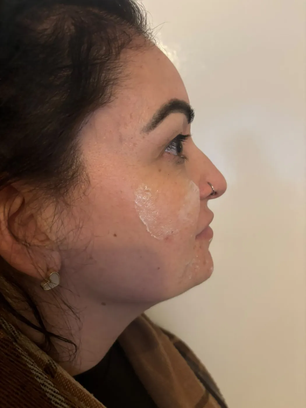 Numbing cream on the cheek before skin boosters in Oakham