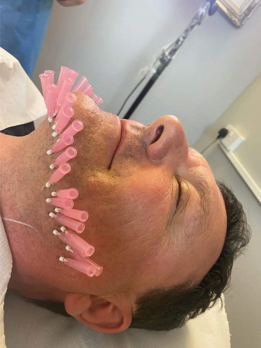 Jawline and chin contouring treatment in Oakham, Rutland