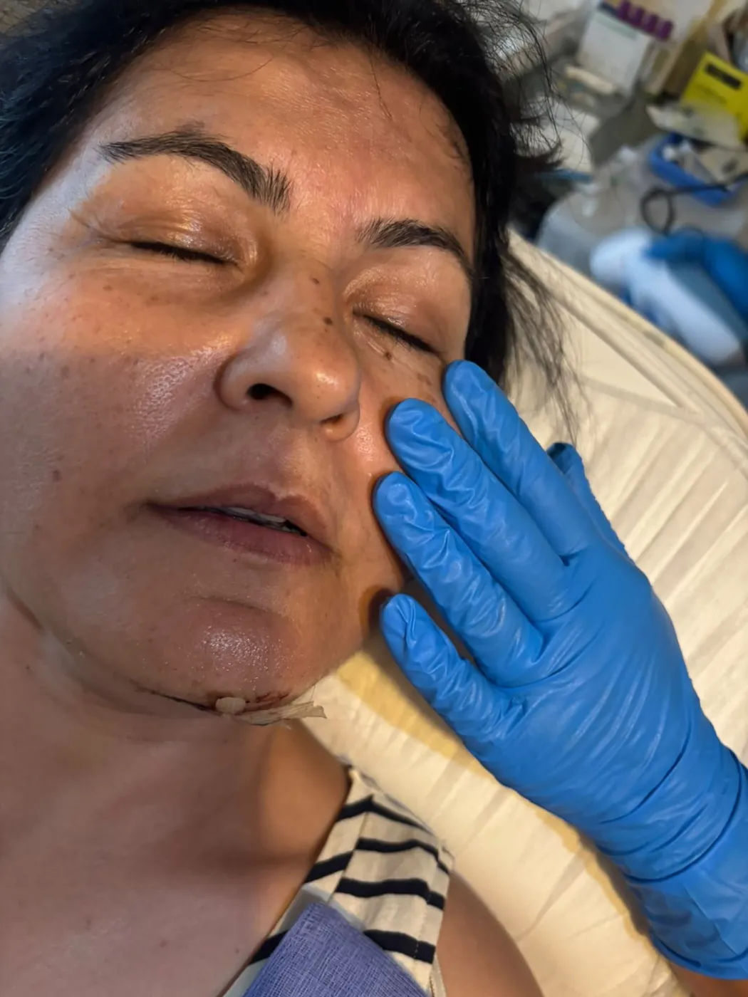 Mini face lift treatment at the jawline with Mel Barge, Oakham