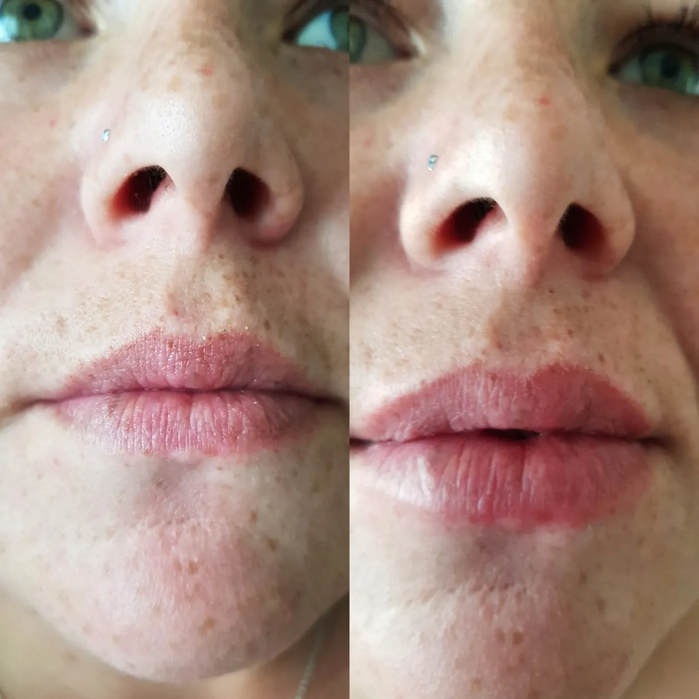 Before and after lip filler at Pre-emptive Aesthetics, Oakham