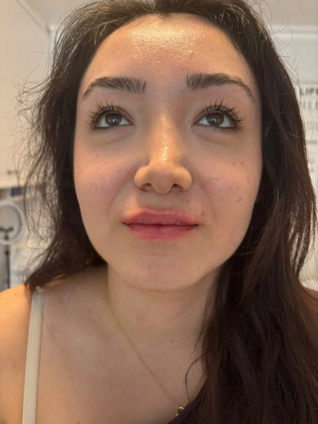 After lip filler – Lips immediately after lip filler treatment in Oakham