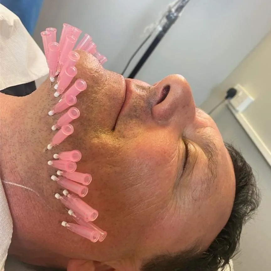 Non-surgical jawline lift treatment in progress in Oakham